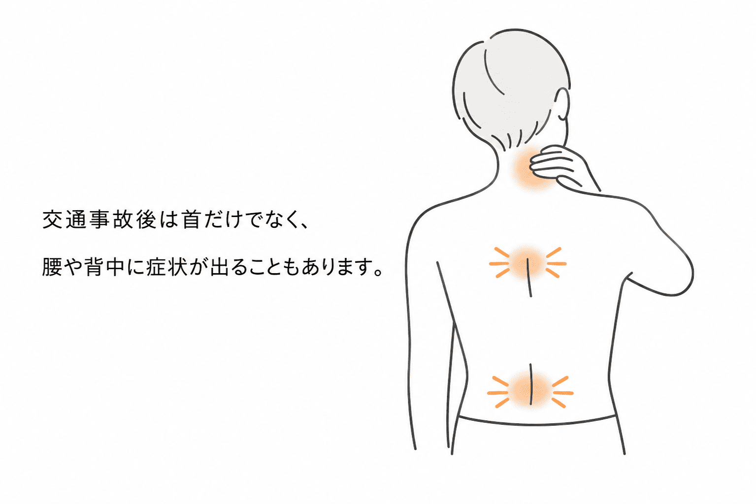 交通事故後は首だけでなく、腰や背中に症状が出ることがあることを示すイラスト